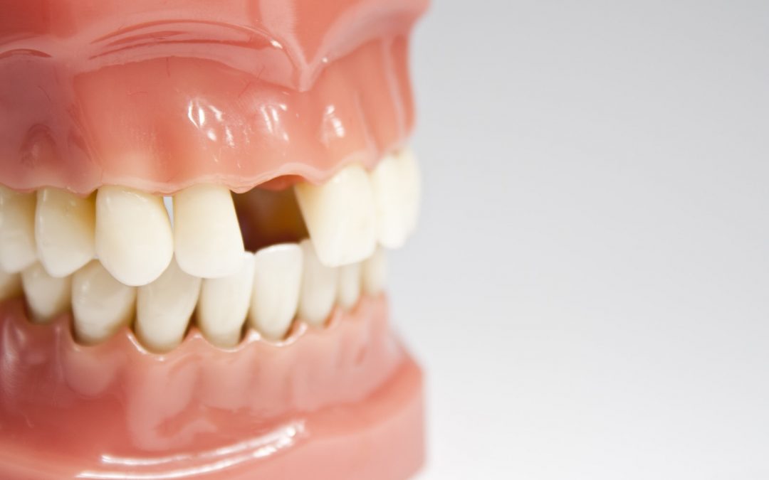 La perte des dents est-elle inévitable avec l’âge ?